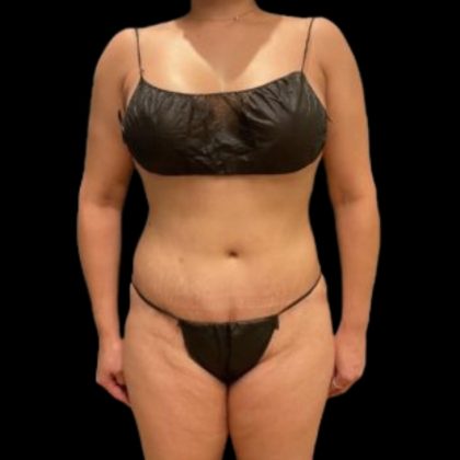 Tummy Tuck Before & After Patient #5074