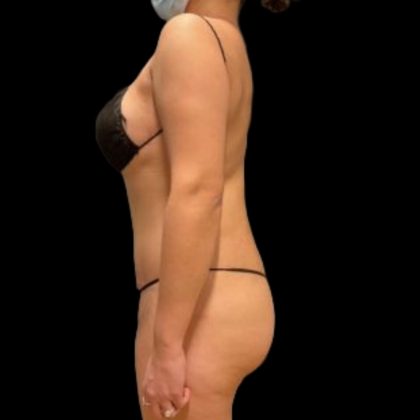 Tummy Tuck Before & After Patient #5074