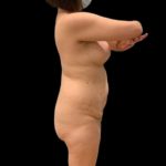 Tummy Tuck Before & After Patient #5074