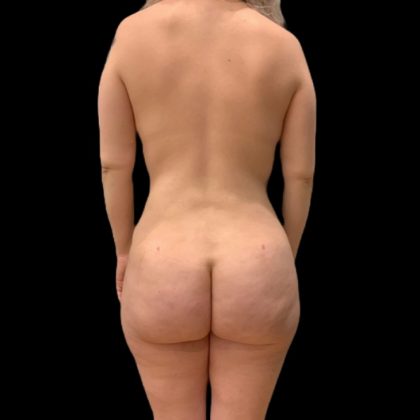Tummy Tuck Before & After Patient #5075