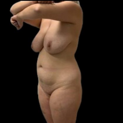 Tummy Tuck Before & After Patient #5075