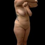 Tummy Tuck Before & After Patient #5075