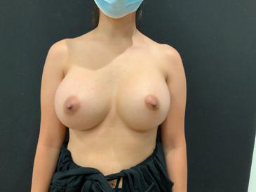 Breast Augmentation Before & After Patient #5450