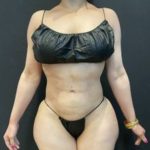 Rib Repositioning Before & After Patient #5587