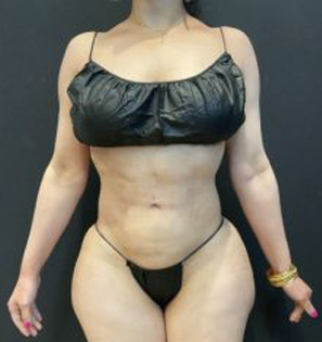 Rib Repositioning Before & After Patient #5587