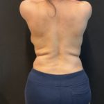 Rib Repositioning Before & After Patient #5587
