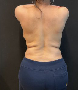 Rib Repositioning Before & After Patient #5587