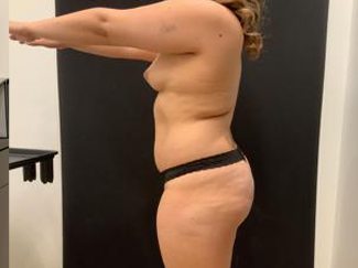 Brazilian Butt Lift Before & After Patient #5344