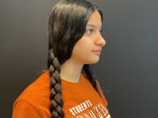 Rhinoplasty Before & After Patient #5376