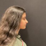 Rhinoplasty Before & After Patient #5376
