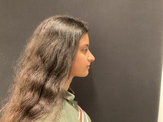 Rhinoplasty Before & After Patient #5376