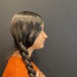 Rhinoplasty Before & After Patient #5376