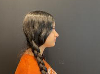Rhinoplasty Before & After Patient #5376