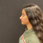Rhinoplasty Before & After Patient #5376