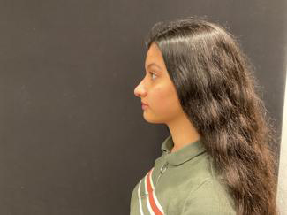 Rhinoplasty Before & After Patient #5376