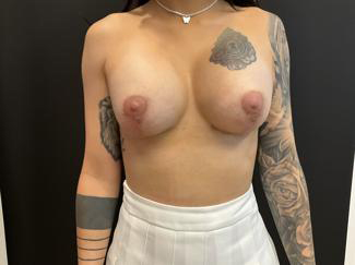 Breast Lift Before & After Patient #5398