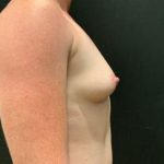 Breast Augmentation Before & After Patient #5421