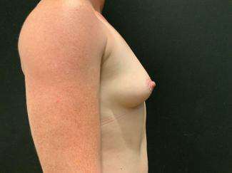 Breast Augmentation Before & After Patient #5421