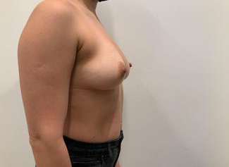 Breast Augmentation Before & After Patient #5432