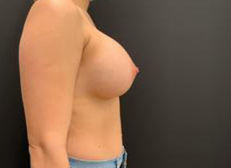 Breast Augmentation Before & After Patient #5432