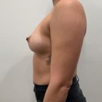 Breast Augmentation Before & After Patient #5432