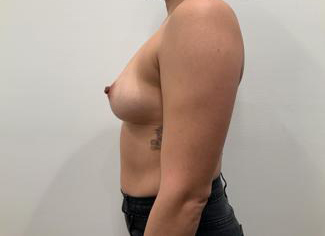 Breast Augmentation Before & After Patient #5432