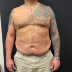 The Skinny Shot Before & After Patient #5476