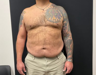 The Skinny Shot Before & After Patient #5476