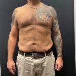 The Skinny Shot Before & After Patient #5476