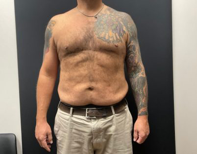 The Skinny Shot Before & After Patient #5476
