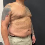 The Skinny Shot Before & After Patient #5476