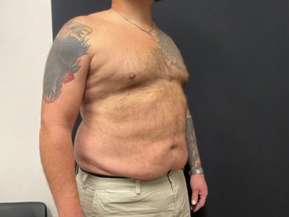 The Skinny Shot Before & After Patient #5476