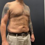 The Skinny Shot Before & After Patient #5476