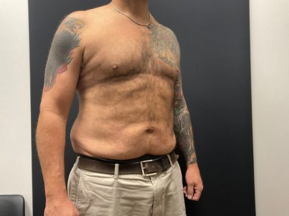 The Skinny Shot Before & After Patient #5476
