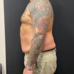 The Skinny Shot Before & After Patient #5476
