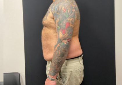 The Skinny Shot Before & After Patient #5476