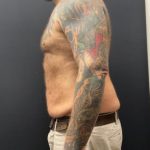 The Skinny Shot Before & After Patient #5476