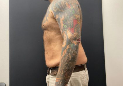 The Skinny Shot Before & After Patient #5476