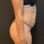 High Definition Liposuction Before & After Patient #5560