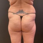 Aveli (Cellulite Removal) Before & After Patient #6436