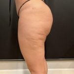 Aveli (Cellulite Removal) Before & After Patient #6442