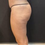 Aveli (Cellulite Removal) Before & After Patient #6442