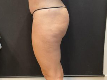 Aveli (Cellulite Removal) Before & After Patient #6442