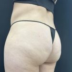 Aveli (Cellulite Removal) Before & After Patient #6443