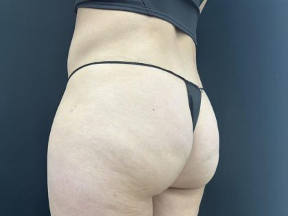 Aveli (Cellulite Removal) Before & After Patient #6443