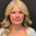 Facelift Before & After Patient #6493