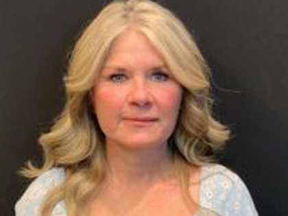 Facelift Before & After Patient #6493