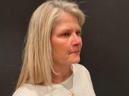 Facelift Before & After Patient #6493