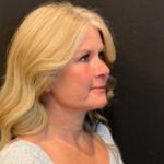 Facelift Before & After Patient #6493