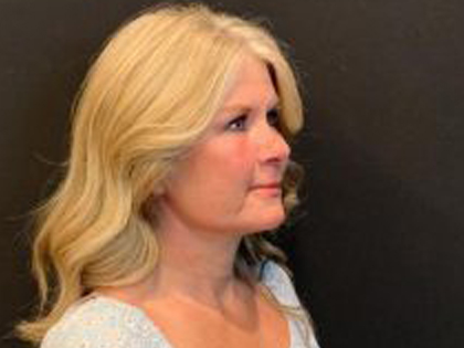 Facelift Before & After Patient #6493